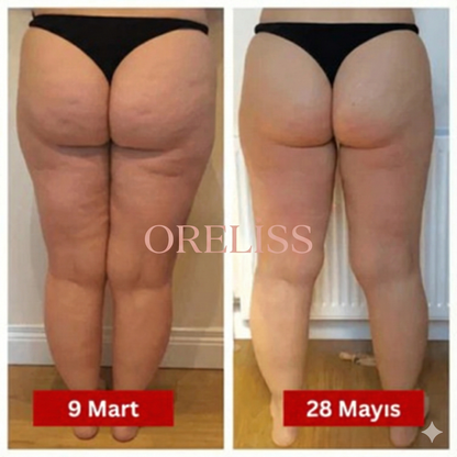 3'lü Etki Taytı Lipödem, Selülit, Varis Oreliss™